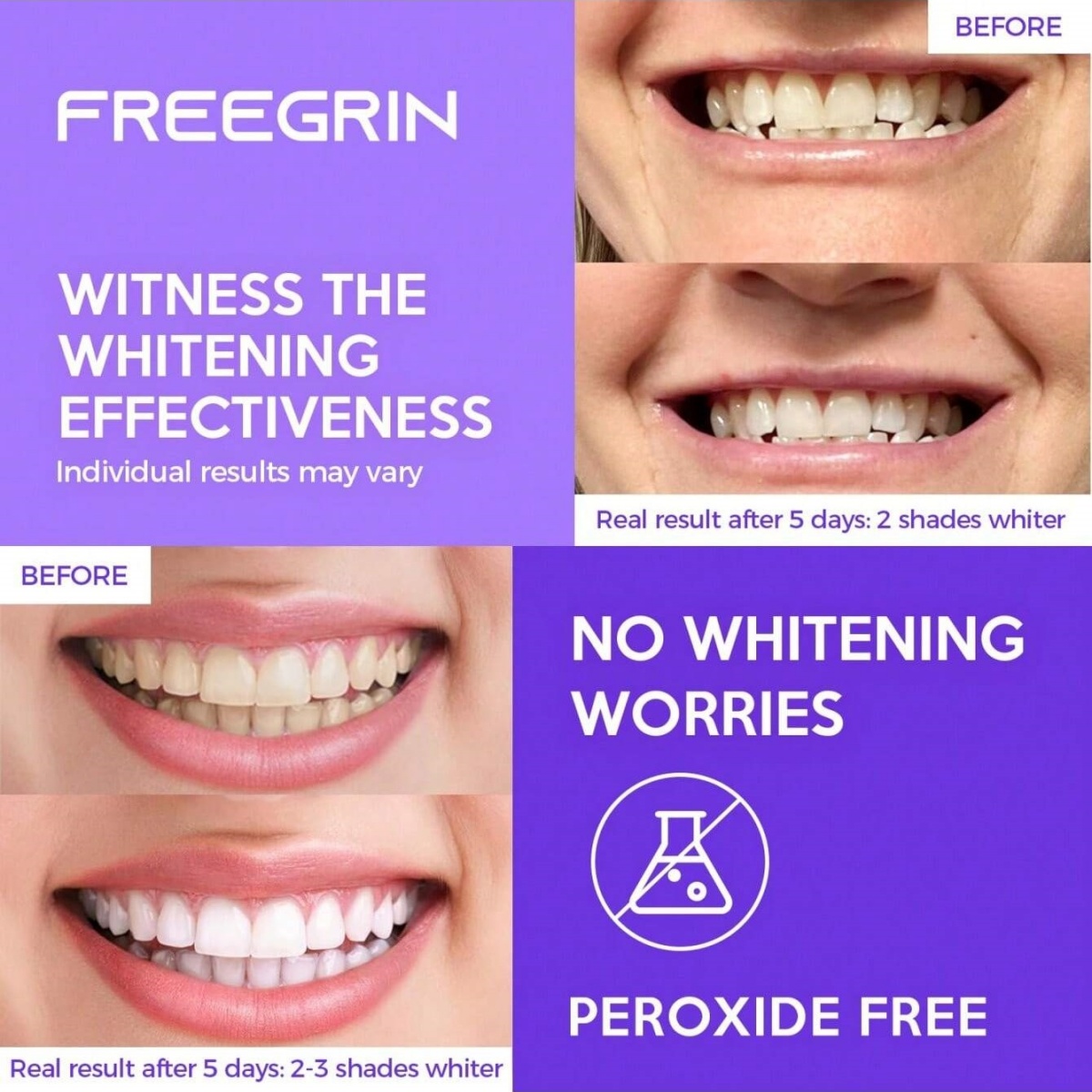 Роскошные отбеливающие наклейк – обзор и цена Teeth Whitening Near Me